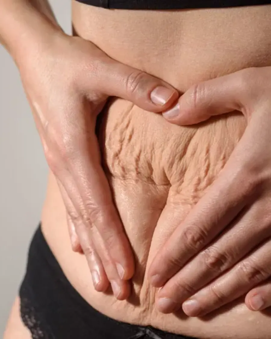 Advanced Stretch Mark Reduction Treatments at Cinch Clinics